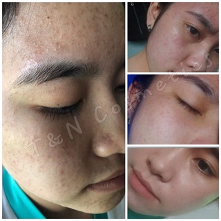 Serum diếp cá Igreen