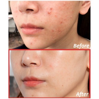 ngoclan Kem Dưỡng Hỗ Trợ Giảm Mụn "14 Ngày" Some By Mi AHA/BHA/PHA 14 Days Super Miracle Spot All Kill Cream 30ml