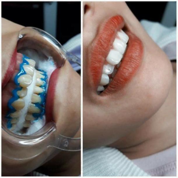 Dụng cụ banh miệng làm tẩy trắng răng