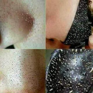 Lột mụn than tre hoạt tính
