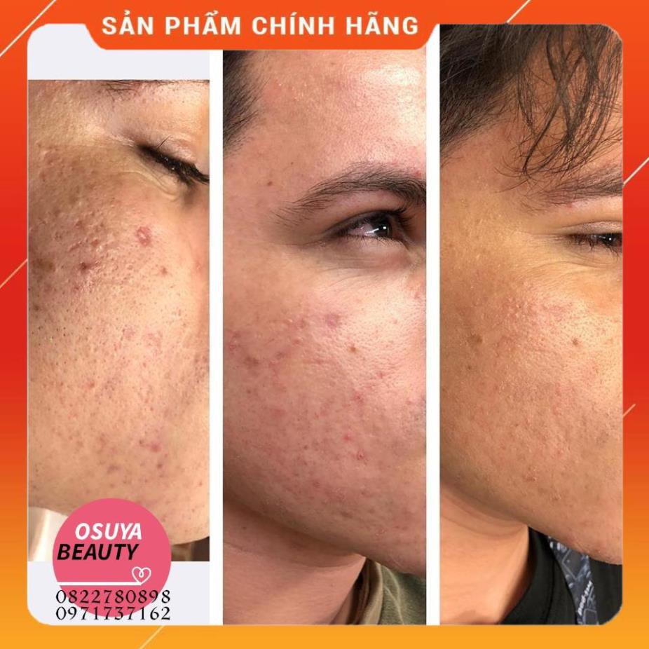 [Hàng Xịn] Gel Trị Mụn Trứng Cá Và Mụn Đầu Đen Cao Cấp Fixderma Luxury FCL Alpha-Beta Acne Gel 30ml