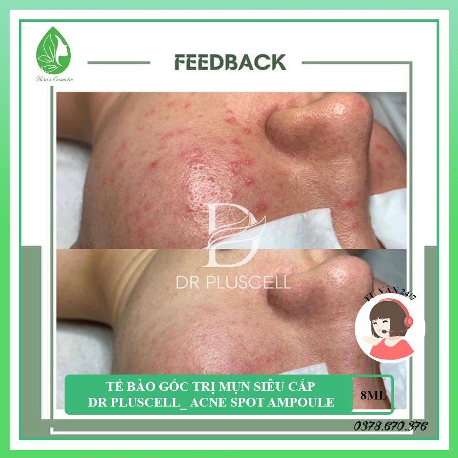 Tế bào gốc mụn 4S Dr Pluscell_ Ance spot ampoule loại bỏ mụn thần tốc