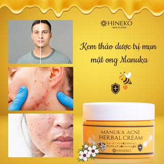 𝐊𝐞𝐦 𝐭𝐡𝐚̉𝐨 𝐝𝐮̛𝐨̛̣𝐜 𝐭𝐫𝐢̣ 𝐦𝐮̣𝐧 𝐦𝐚̣̂𝐭 𝐨𝐧𝐠 𝐌𝐚𝐧𝐮𝐤𝐚,  Hineko 100% nhập khẩu Nhật Bản