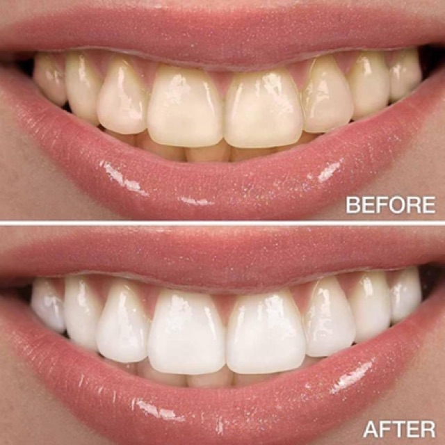 KEM ĐÁNH RĂNG MEDIAN DENTAL IQ 93% TOOTHPASTE