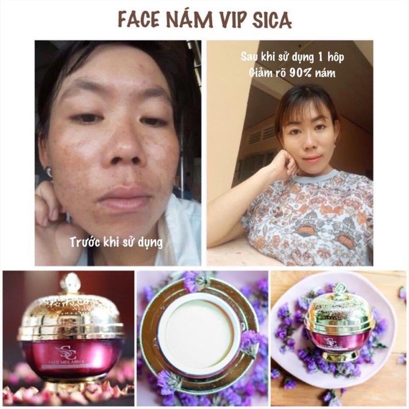 FACE MELASMA- KEM NÁM VIP