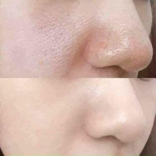 Tế bào gốc POCIA se khít lỗ chân lông