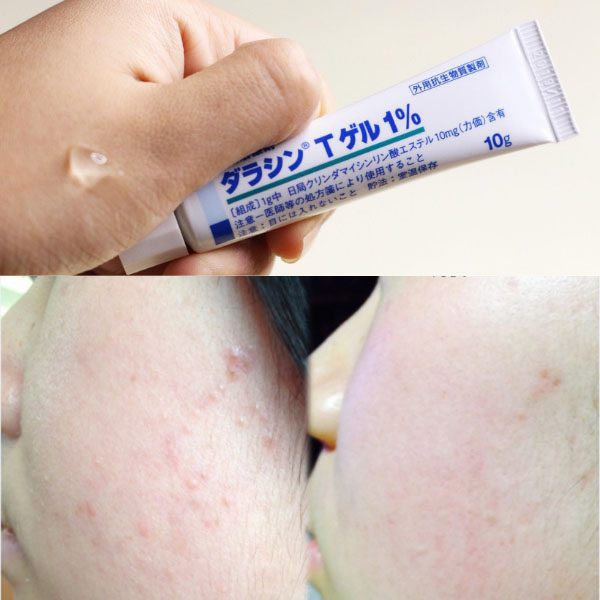 Kem giảm mụn Sato Nhật Bản 1% tuýp 10g chính hãng | BigBuy360 - bigbuy360.vn