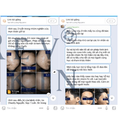Kem Chấm Mụn RevSkin Acne Cream 10g giảm mụn sáng da, mờ thâm dược mỹ phẩm hàng chính hãng shop Hello Sun