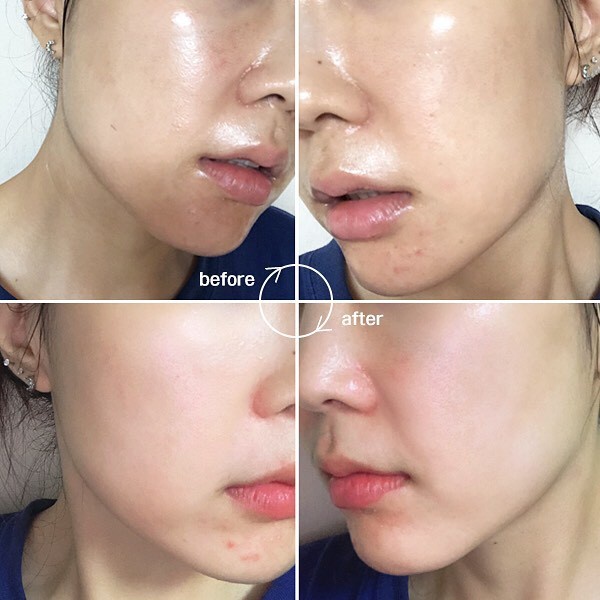 [DR NDS MASK - DR.CHUBBY REVIEW] Bộ mặt nạ ampoule nâng cơ, làm sáng và chống lão hoá Dr.NDS Vlifting &amp; Brightening mask