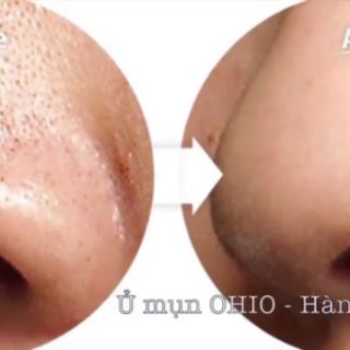 Ủ mụn OHIO - Hàn Quốc