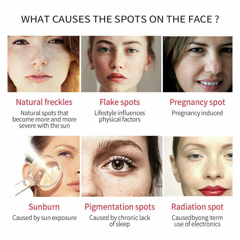 Kem Làm Trắng Và Loại Bỏ Các Hắc Tốt Melanin Và Chăm Sóc Da Trắng Sáng Tự Nhiên Kem Chăm