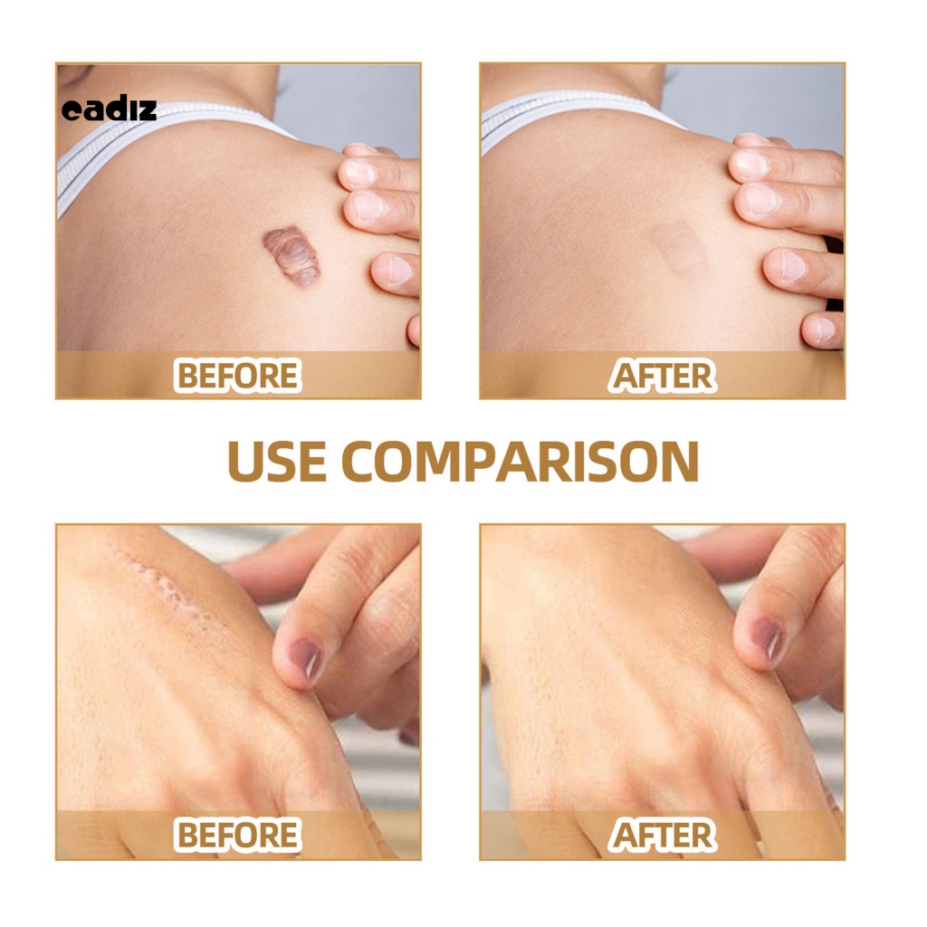 Miếng Dán Hỗ trợ giảm sẹo Dịu Nhẹ Cho Nữ