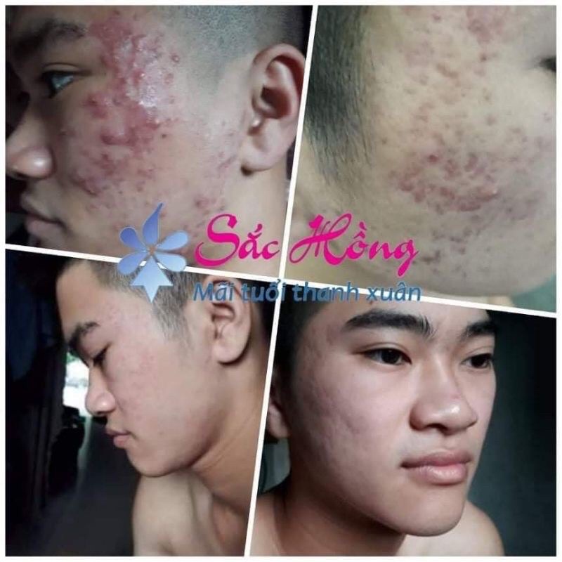 TINH CHẤT NGỪA MỤN NÁM SẮC HỒNG