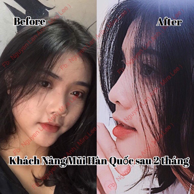 Serum Nâng Cao Mũi Hàn