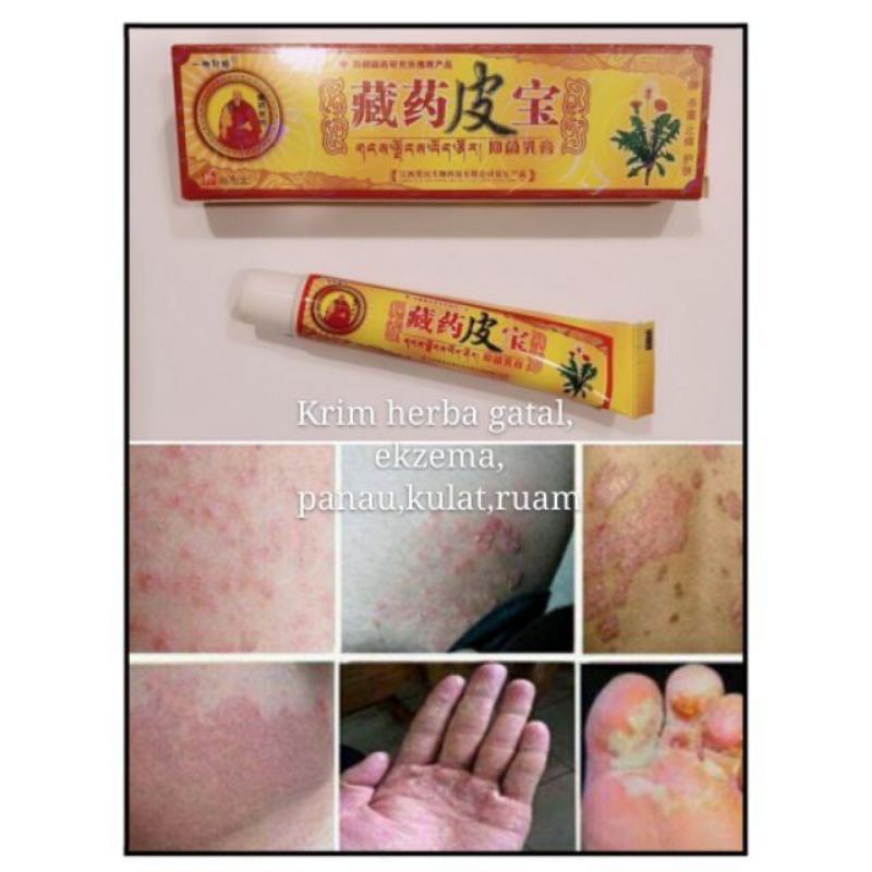 Kem bôi ngứa, lang, nấm, zona, hắc lào, ghẻ nước,nấm da đầu ,vẩy nến