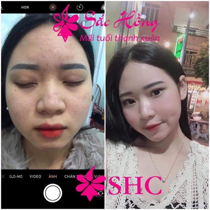 Tinh Chất Sắc Hồng Ngừa Mụn Nám