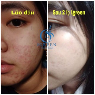 Serum Igreen_ đánh bay mụn, ngừa mụn.