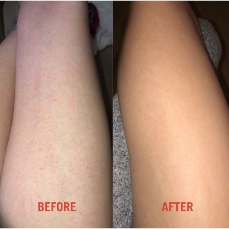 Tẩy da chết & Dưỡng thể body First Aid Beauty KP Bump Eraser Body Scrub 226g