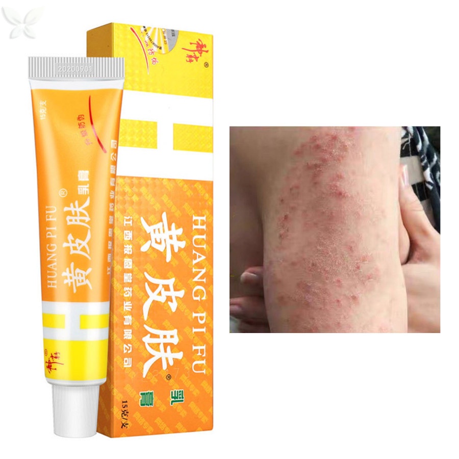 Kem Thảo Dược Hỗ trợ giảm vẩy nến / Chàm Chống Ngứa Hiệu Quả