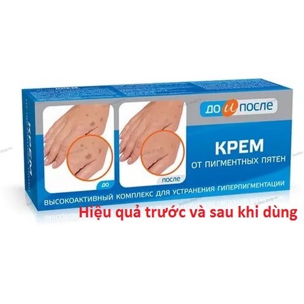 Kem bôi mờ đồi mồi Nga Kpem