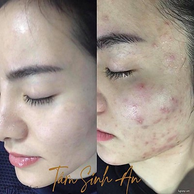 Cây Nặn Mụn 2 Đầu FREESHIPQue Nặn Mụn Cao Cấp - Tiệt Trùng, Sát Khuẩn  Tâm Sinh An Cosmetic - Mãi Mãi Tuổi 18