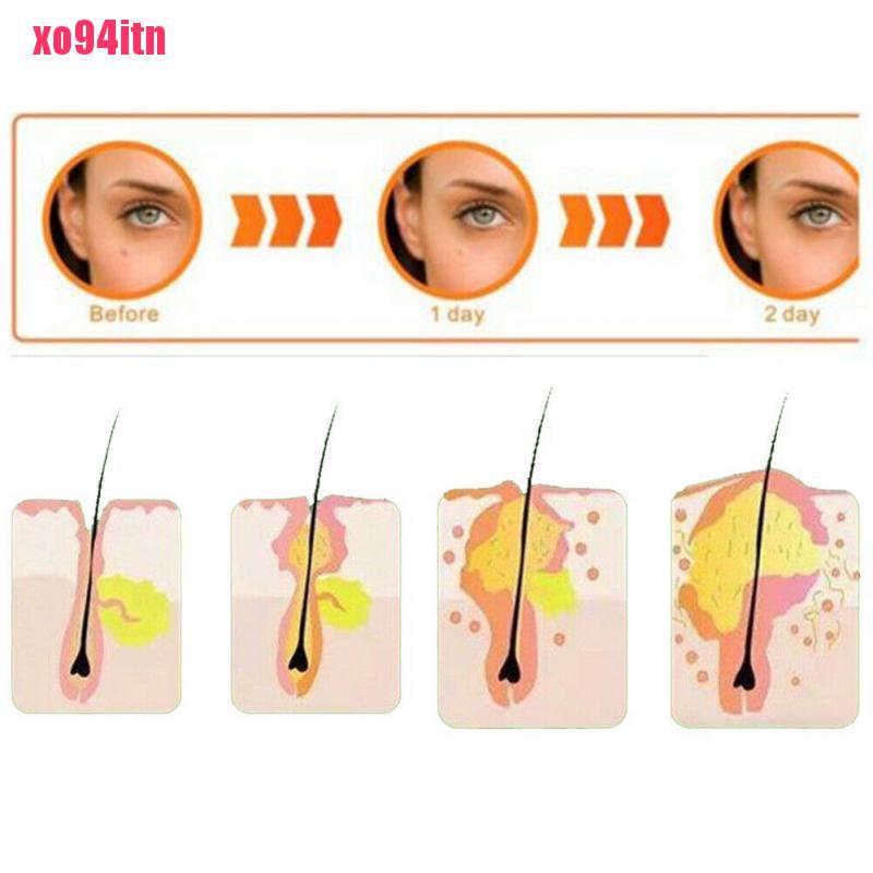 [Hàng mới về] Set 36 miếng dán hỗ trợ giảm mụn hydrocolloid hiệu quả