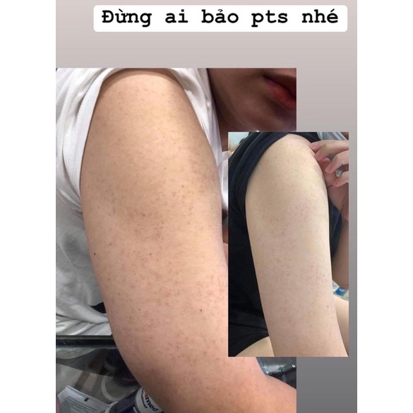 KELA LOTION DÙNG CHO VIÊM LỖ CHÂN LÔNG 30ml Thái Lan