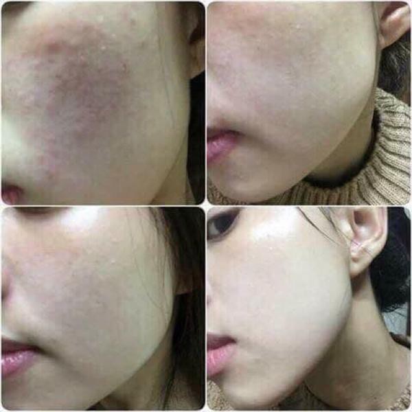 Gel Sụn Cá Hồi Giúp Hồi Phục Da PG Collagen Morepas Care Ex