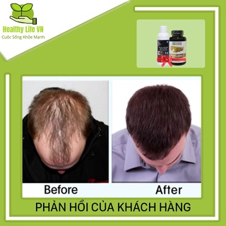 Combo Mọc Tóc Hói Morr F5 + HairFluence
