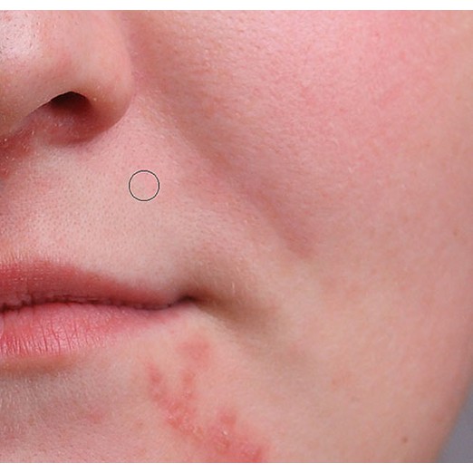 Cây nặn mụn inox MiraCulous Pimple Remover Tool Cao cấp Hàn Quốc - Hàng chính hãng