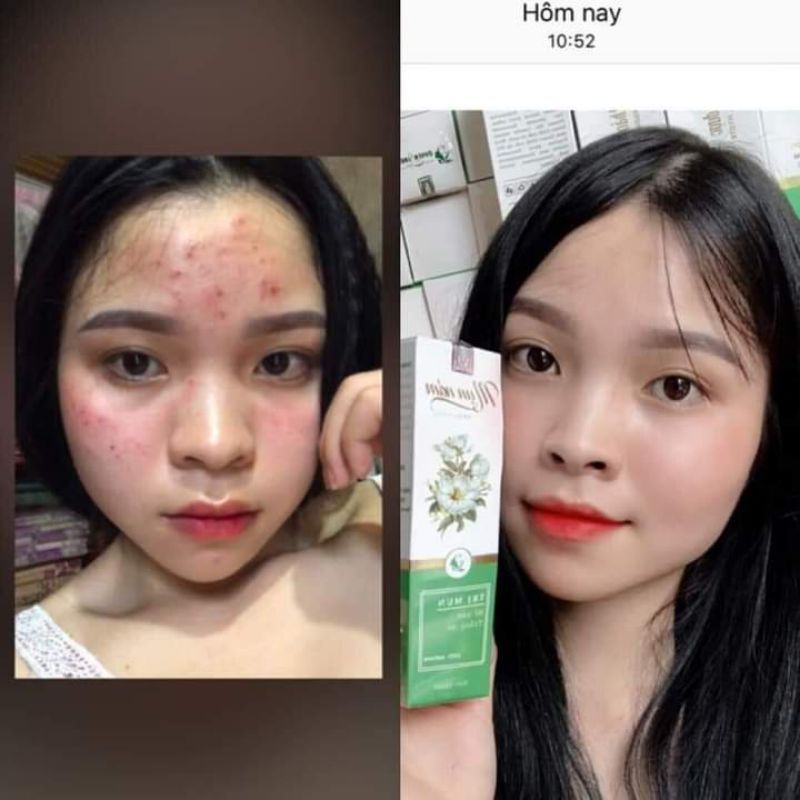 Mụn Nám Thảo Dược Quyên Lara Đánh Bay Mụn,Nám.Tàn Nhang,Tái Tạo Lại Làn Da Mới An Toàn,Hiệu Quả Sau 1 Liệu Trình 120ml