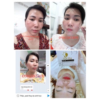 SÉT TCA CHẤM PEEL NÁM TÀN NHANG 35%