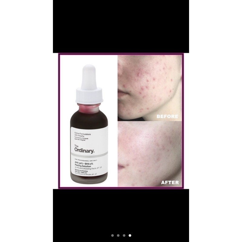 The Ordinary AHA 30% + BHA 2% Peeling Solution