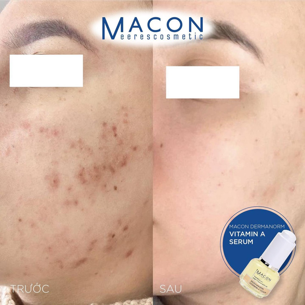 Serum Vitamin A Cho Da Mụn Thâm - Hương Chất Cosmetic