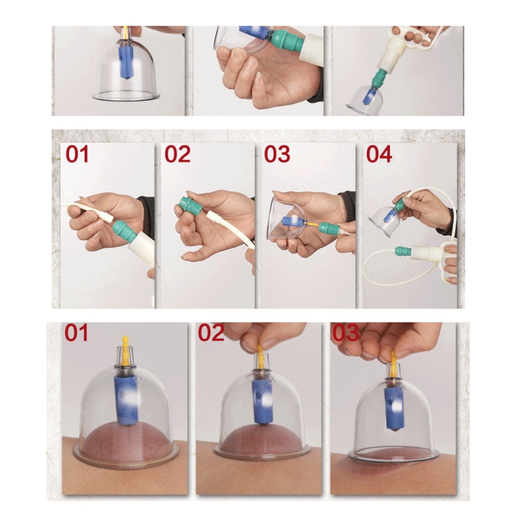 Bộ Giác Hơi Không Lửa 32 Cốc, Bộ Giác Hơi Chân Không 32 Ly Nhựa Cứng Loại 1