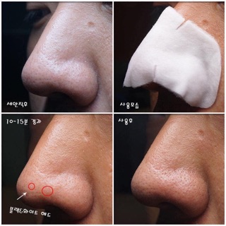 Miếng ủ mụn