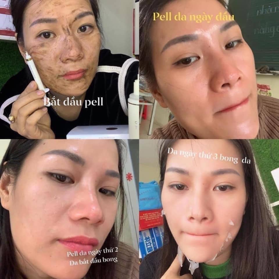 THAY DA SINH HỌC DERMA SKIN Peeling BQ CELL