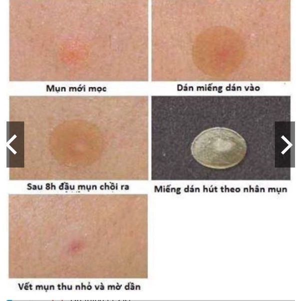 Miếng dán mụn Mayan care | BigBuy360 - bigbuy360.vn