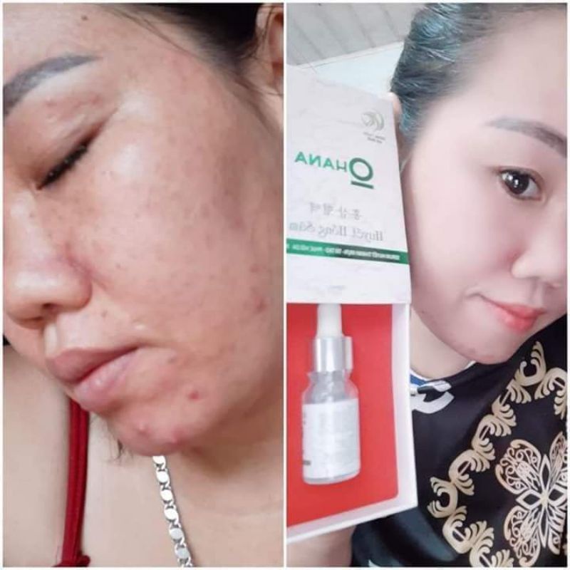 Huyết Hồng Sâm diệt Mụn (10m) |Đông Dược Vũ Đức | BigBuy360 - bigbuy360.vn