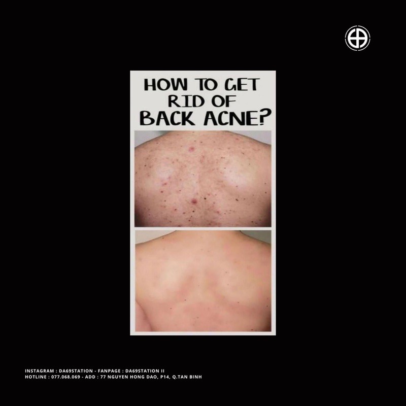 bộ sản phẩm dưỡng da body chống mụn thâm | BigBuy360 - bigbuy360.vn