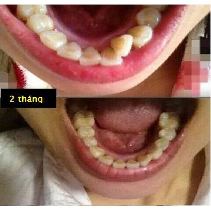 [FREE SHIP] Dụng Cụ Niềng Răng Tại Nhà ( 3 giai đoạn)