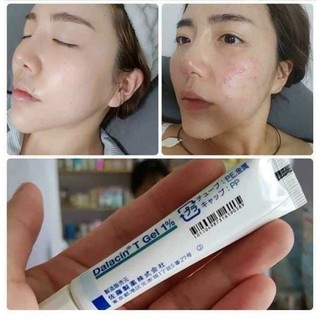 GEL TRI MUN TGEL CỦA NHẬT.