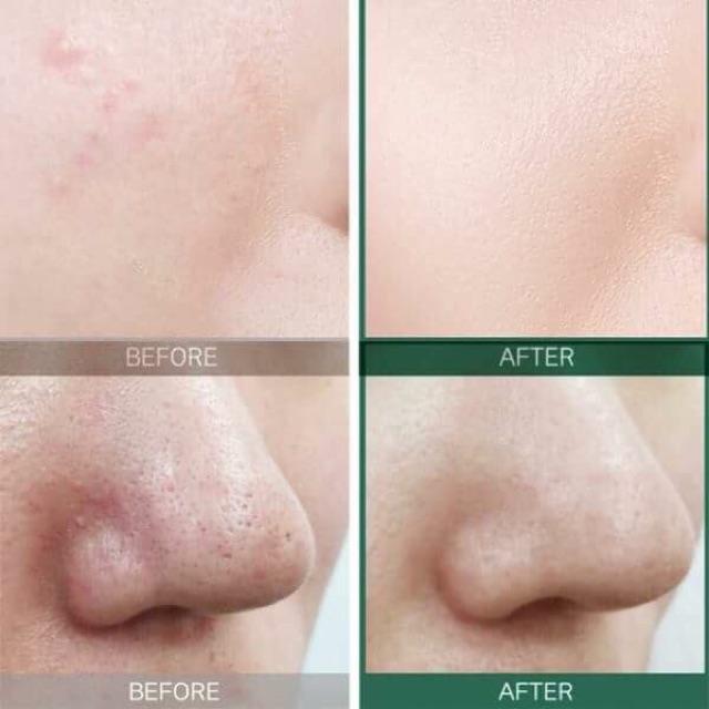 ( Sẵn ) Toner mụn 30 ngày Some By Mi AHA-BHA-PHA 30 Days Miracle Toner | BigBuy360 - bigbuy360.vn