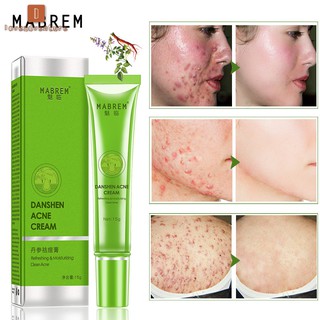 Tuýp kem Hỗ Trợ Giảm mụn thu nhỏ lỗ chân lông kiểm soát dầu