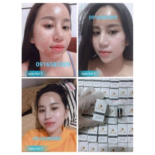 SÉT TCA CHẤM PEEL NÁM TÀN NHANG 35%
