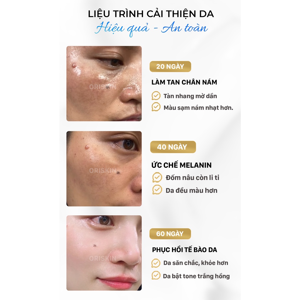 Kem Ngăn Ngừa Nám Tàn Nhang Oriskin Melasma & Whitening Cream