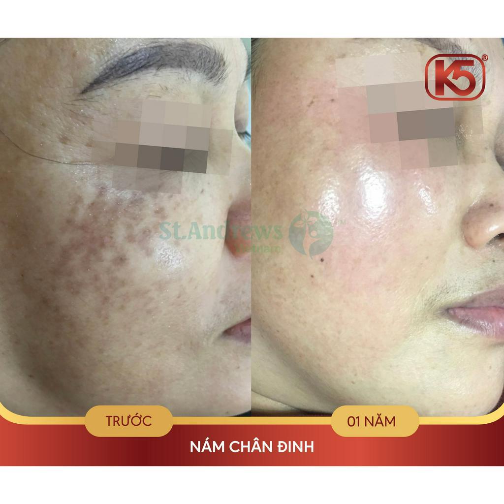 Kem chống tăng sắc tố sau lăn kim, phi kim tốt nhất hiện nay K5 Cryolaser 20ml