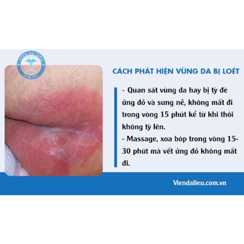 Gel Activheal Hydrogel bôi liền vết thương hở vết loét tì đè,vết loét tiểu đường vết bỏng trầy xước nhập khẩu Anh Quốc