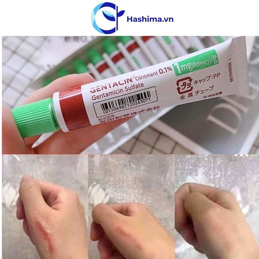 Gentacin - Kem sẹo Gentacin Nhật Bản - Giảm thiểu việc hình thành sẹo và mụn | BigBuy360 - bigbuy360.vn