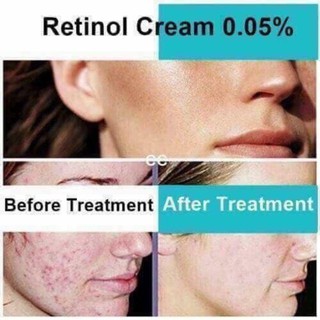 [HÀNG CÓ SẴN] Kem trị mụn Retin A cream